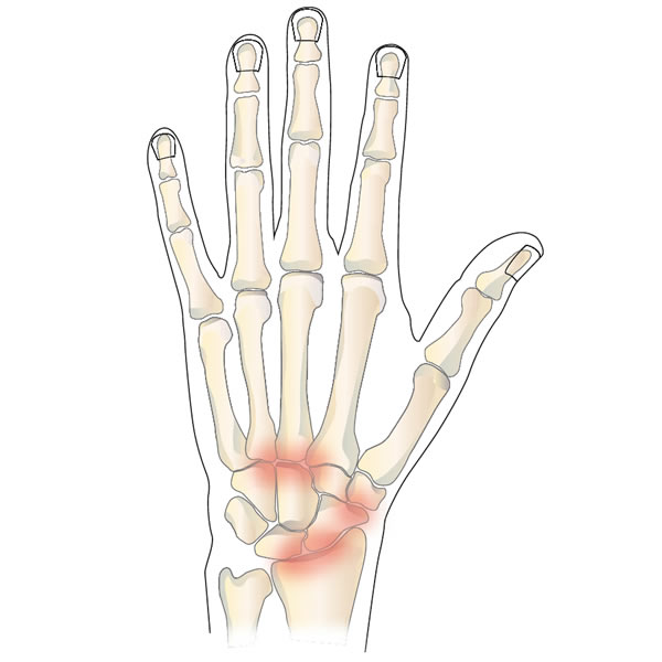 Arthritis of the Wrist or Hand