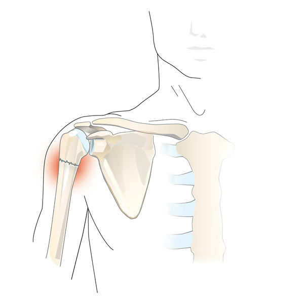Перелом головки плечевой кости