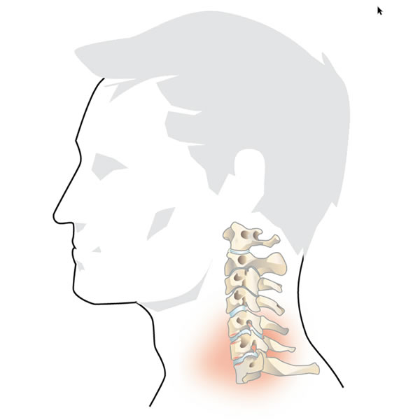 Degeneration of the Cervical Spine