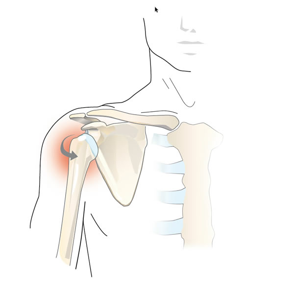 Ausgekugelte Schulter (instabile Schulter oder Subluxation der Schulter)