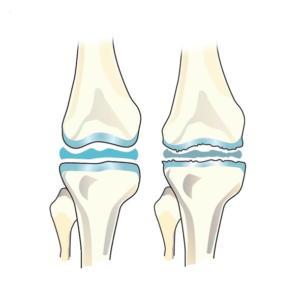 Knee Osteoarthritis