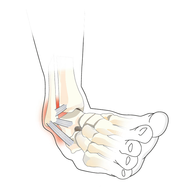 Ankle Ligament Injury