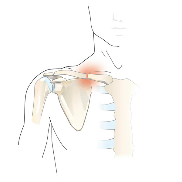 Fracture de la clavicule