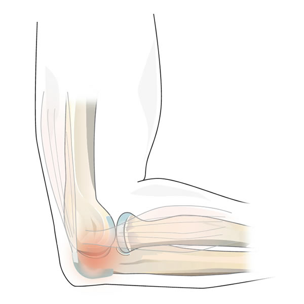 Inflammation of the Elbow Bursa 
