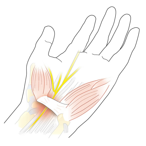 Carpal Tunnel Syndrome