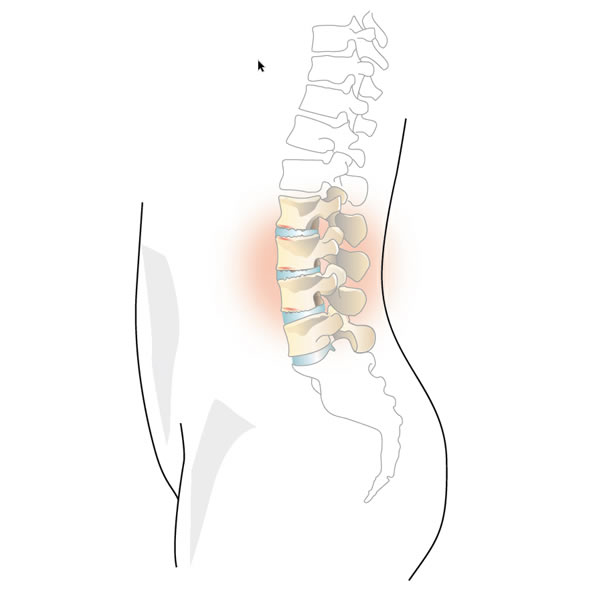 Degeneraci&#243;n de las v&#233;rtebras lumbares