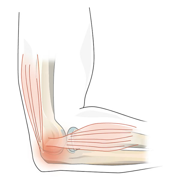 Tennis-elbow (&#233;picondylite lat&#233;rale)