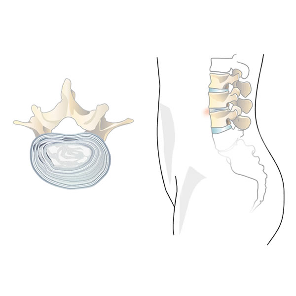 Disco herniado