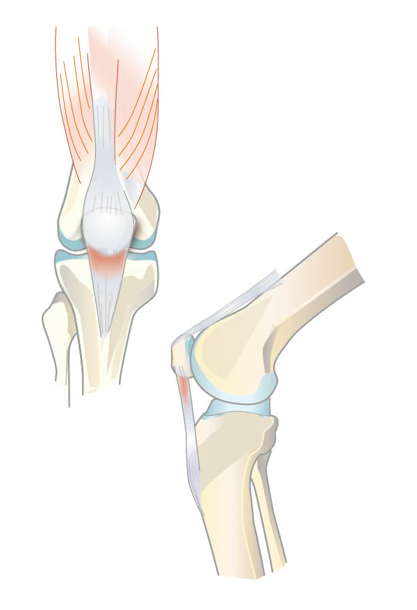 Tendinitis rotuliana (rodilla de saltador)