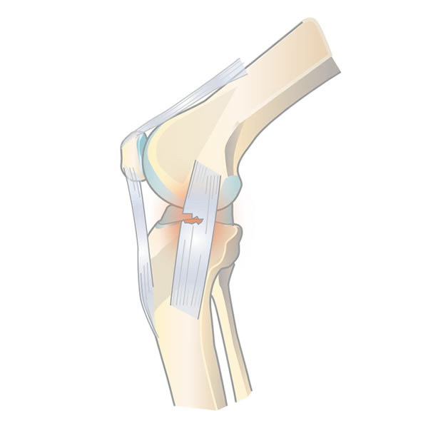 L&#233;sion du ligament m&#233;dial du genou