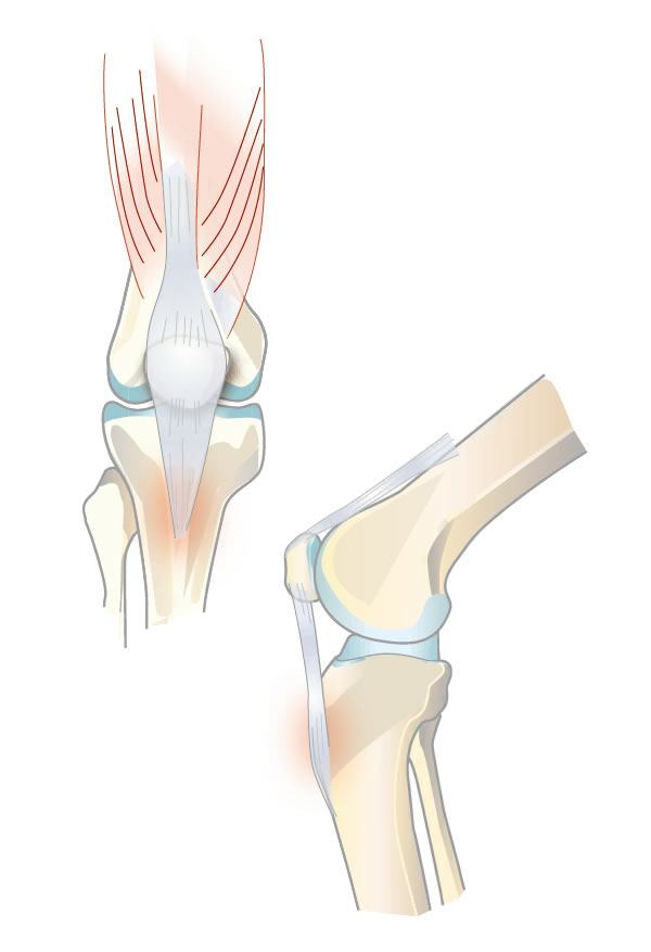 Osgood-Schlatter