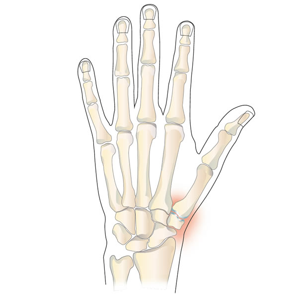 Osteoartrosi della base del pollice (CMC-I)