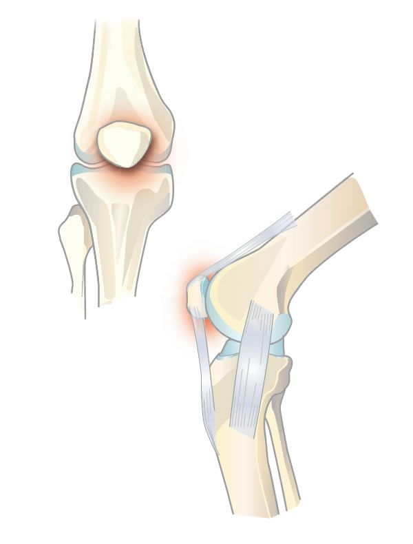 syndrome douloureux f&#233;moro-patellaire