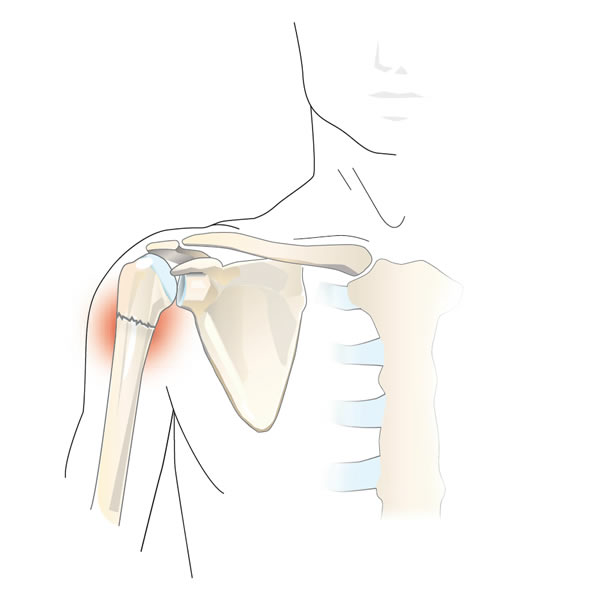 Frattura della testa dell’omero