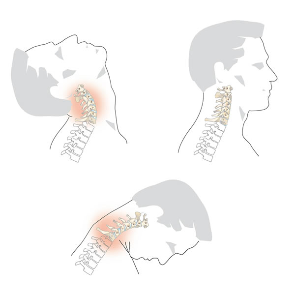 Coup de fouet cervical