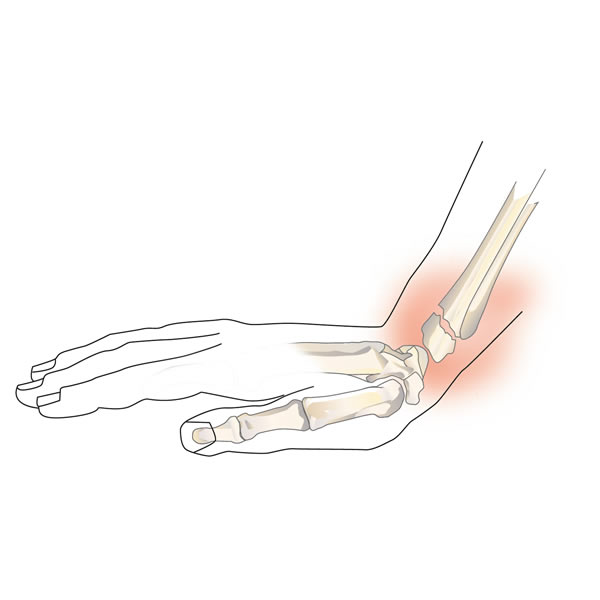 Fractura de mu&#241;eca